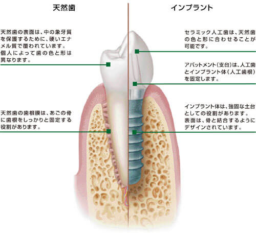 インプラントで自分の歯と変わらない生活が可能になります