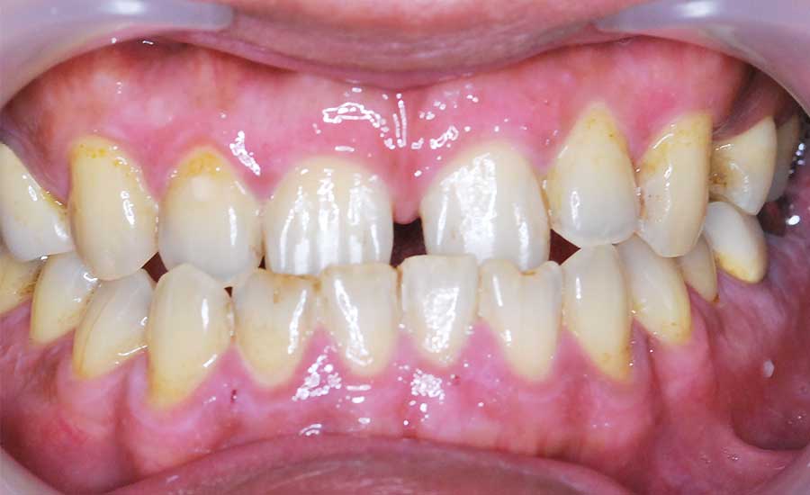 かさぶた状になってから、1〜2週間で綺麗なピンク色の歯茎が現れます。