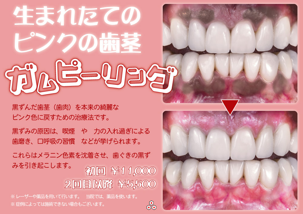ガムピーリングで歯茎が健康的なピンク色に回復します