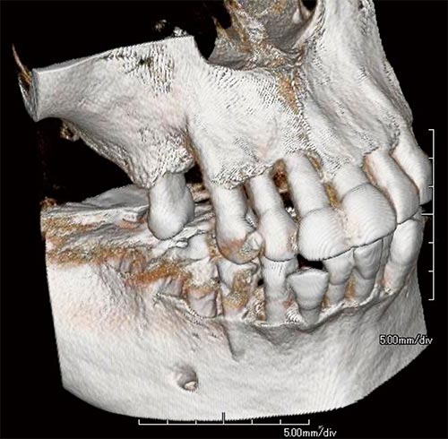歯科中橋では歯科用CTを利用してインプラント治療のシミュレーションを行ってから施述をすることが可能です