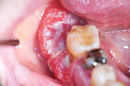 歯槽膿漏などに似ていても、違和感を感じる場合は診察して安心してください。