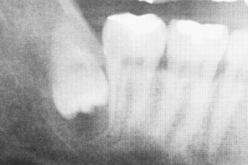 親知らずの抜歯のためにレントゲンやCTを撮影すると確度が増します